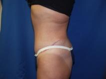 Tummy Tuck After Photo by Paul Ringelman, MD; Towson, MD - Case 7572