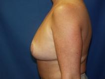 Breast Reduction After Photo by Paul Ringelman, MD; Towson, MD - Case 7575