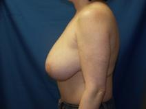Breast Reduction Before Photo by Paul Ringelman, MD; Towson, MD - Case 7575