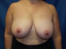 Breast Reduction Before Photo by Paul Ringelman, MD; Towson, MD - Case 7576