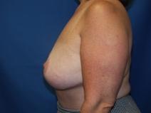 Breast Reduction After Photo by Paul Ringelman, MD; Towson, MD - Case 7576