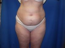 Liposuction Before Photo by Paul Ringelman, MD; Towson, MD - Case 7578