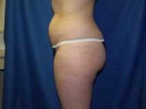 Liposuction Before Photo by Paul Ringelman, MD; Towson, MD - Case 7579