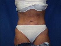 Tummy Tuck After Photo by Paul Ringelman, MD; Towson, MD - Case 7581