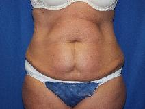 Tummy Tuck Before Photo by Paul Ringelman, MD; Towson, MD - Case 7581