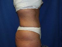 Tummy Tuck After Photo by Paul Ringelman, MD; Towson, MD - Case 7581