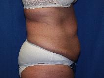 Tummy Tuck Before Photo by Paul Ringelman, MD; Towson, MD - Case 7581