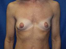 Breast Augmentation Before Photo by Paul Ringelman, MD; Towson, MD - Case 7588