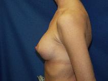 Breast Augmentation After Photo by Paul Ringelman, MD; Towson, MD - Case 7588