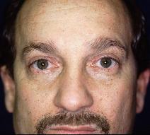 Eyelid Surgery After Photo by Paul Ringelman, MD; Towson, MD - Case 7643