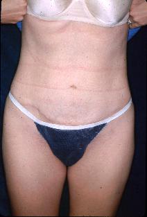 Tummy Tuck After Photo by Paul Ringelman, MD; Towson, MD - Case 7645