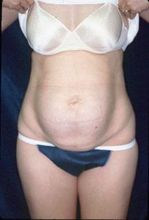 Tummy Tuck Before Photo by Paul Ringelman, MD; Towson, MD - Case 7645