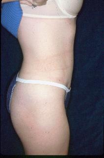 Tummy Tuck After Photo by Paul Ringelman, MD; Towson, MD - Case 7645