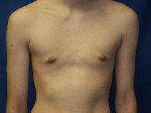 Male Breast Reduction After Photo by Paul Ringelman, MD; Towson, MD - Case 7652