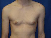 Male Breast Reduction Before Photo by Paul Ringelman, MD; Towson, MD - Case 7652