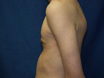 Male Breast Reduction After Photo by Paul Ringelman, MD; Towson, MD - Case 7652