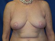 Breast Lift After Photo by Paul Ringelman, MD; Towson, MD - Case 7654