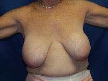 Breast Lift Before Photo by Paul Ringelman, MD; Towson, MD - Case 7654