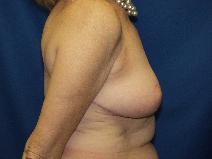 Breast Lift After Photo by Paul Ringelman, MD; Towson, MD - Case 7654
