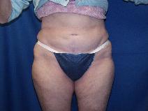 Tummy Tuck After Photo by Paul Ringelman, MD; Towson, MD - Case 7655