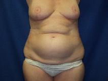 Tummy Tuck Before Photo by Paul Ringelman, MD; Towson, MD - Case 7655