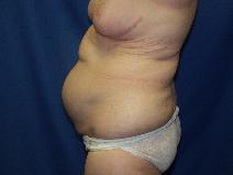 Tummy Tuck Before Photo by Paul Ringelman, MD; Towson, MD - Case 7655