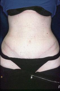 Tummy Tuck After Photo by Paul Ringelman, MD; Towson, MD - Case 7657