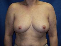 Breast Reduction After Photo by Paul Ringelman, MD; Towson, MD - Case 7679