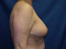 Breast Reduction After Photo by Paul Ringelman, MD; Towson, MD - Case 7679