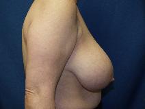Breast Reduction Before Photo by Paul Ringelman, MD; Towson, MD - Case 7679