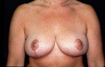 Breast Reduction After Photo by Paul Ringelman, MD; Towson, MD - Case 7682