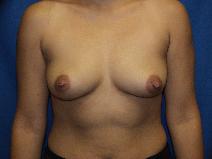 Breast Augmentation Before Photo by Paul Ringelman, MD; Towson, MD - Case 7735