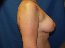 Breast Lift After Photo by Paul Ringelman, MD; Towson, MD - Case 8279