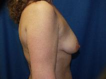 Breast Lift Before Photo by Paul Ringelman, MD; Towson, MD - Case 8279