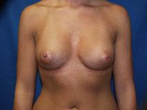 Breast Augmentation After Photo by Paul Ringelman, MD; Towson, MD - Case 8654