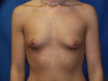 Breast Augmentation Before Photo by Paul Ringelman, MD; Towson, MD - Case 8654