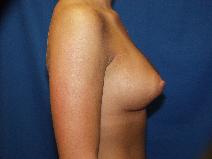 Breast Augmentation After Photo by Paul Ringelman, MD; Towson, MD - Case 8654