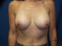 Breast Augmentation After Photo by Paul Ringelman, MD; Towson, MD - Case 8690