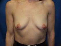 Breast Augmentation Before Photo by Paul Ringelman, MD; Towson, MD - Case 8690