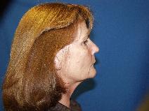 Facelift Before Photo by Paul Ringelman, MD; Towson, MD - Case 8928