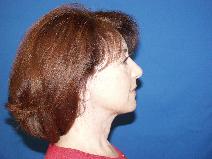 Facelift After Photo by Paul Ringelman, MD; Towson, MD - Case 9275