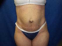 Tummy Tuck Before Photo by Paul Ringelman, MD; Towson, MD - Case 9316