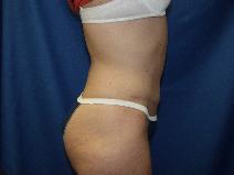 Tummy Tuck After Photo by Paul Ringelman, MD; Towson, MD - Case 9316