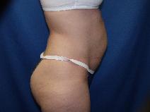 Tummy Tuck Before Photo by Paul Ringelman, MD; Towson, MD - Case 9316