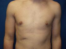 Male Breast Reduction After Photo by Paul Ringelman, MD; Towson, MD - Case 9317
