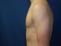 Male Breast Reduction After Photo by Paul Ringelman, MD; Towson, MD - Case 9317