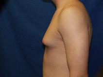 Male Breast Reduction Before Photo by Paul Ringelman, MD; Towson, MD - Case 9317