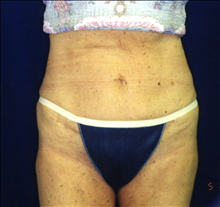 Tummy Tuck After Photo by Mark Gold, MD; Rancho Bernardo, CA - Case 24262