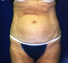 Tummy Tuck Before Photo by Mark Gold, MD; Rancho Bernardo, CA - Case 24262