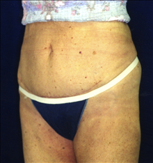 Tummy Tuck After Photo by Mark Gold, MD; Rancho Bernardo, CA - Case 24262
